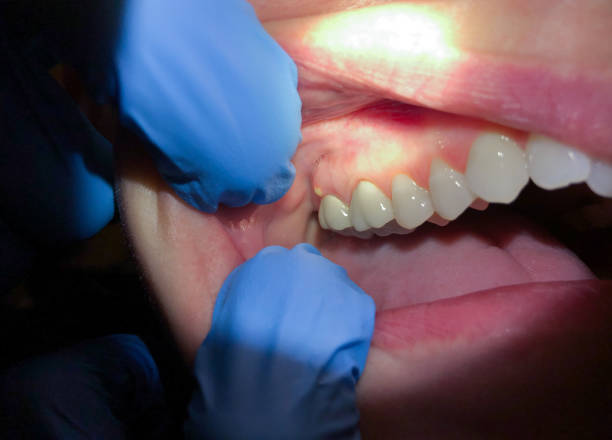 Best Emergency Wisdom Teeth Removal in Bentonville, AR